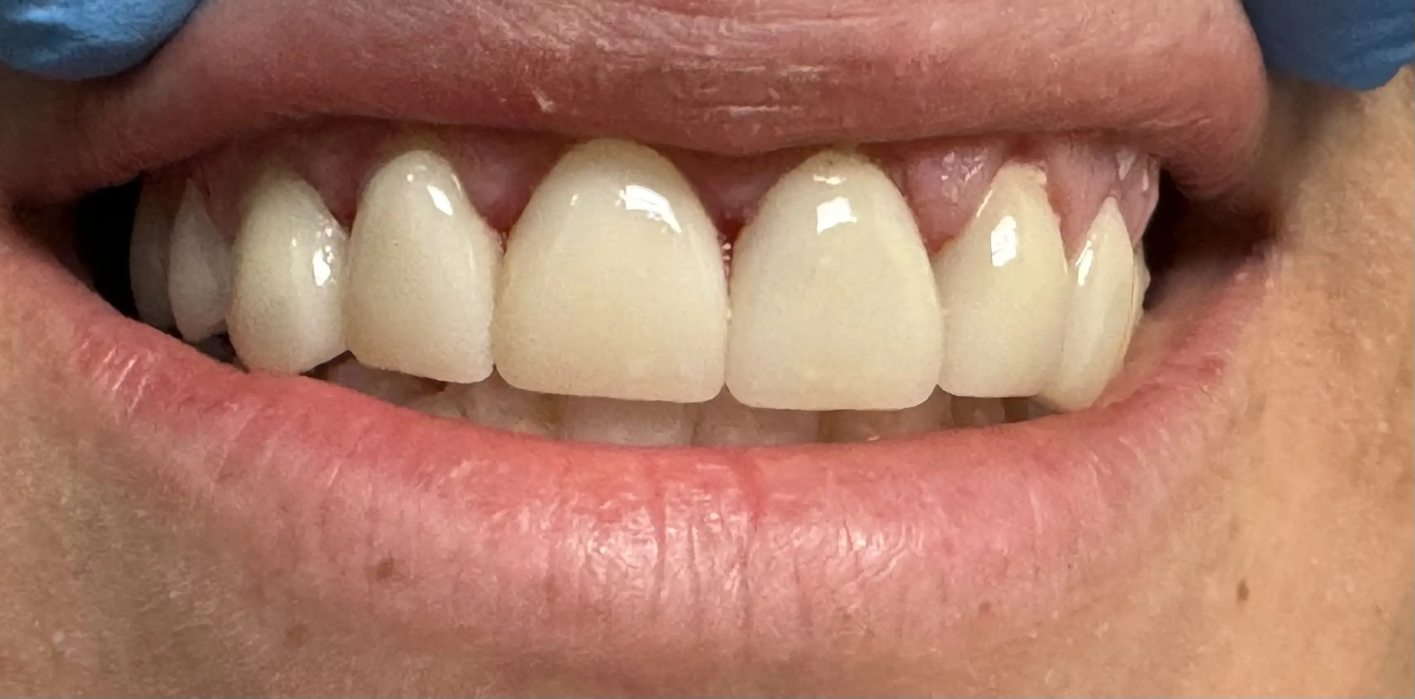 Patient's smile after full coverage crown treatment