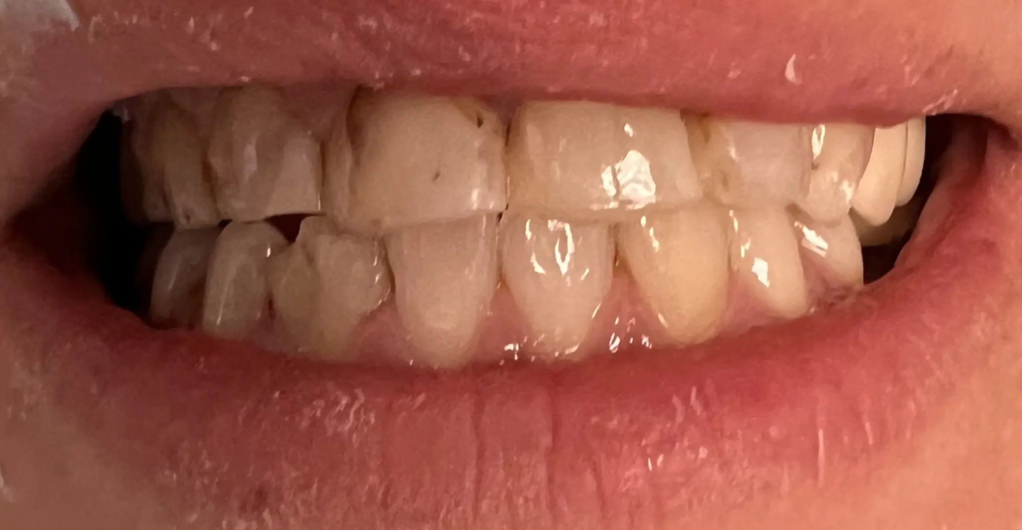 Patient's teeth before full coverage crown treatment
