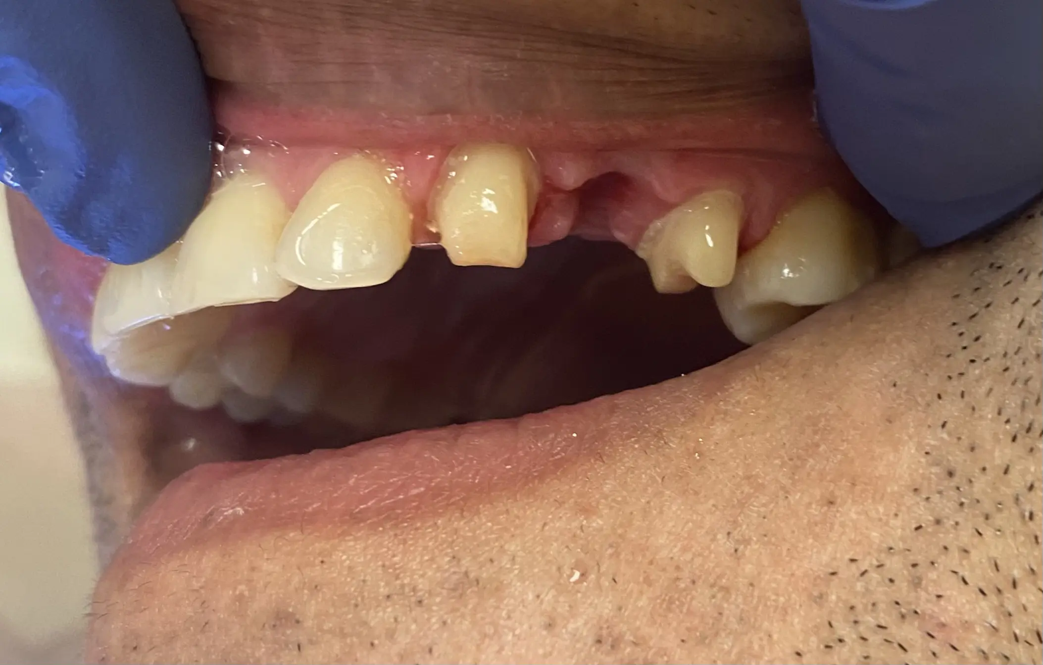 Patient's smile with a missing tooth before zirconium bridge treatment