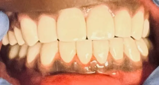 Patient's smile after full coverage zirconium crown treatment