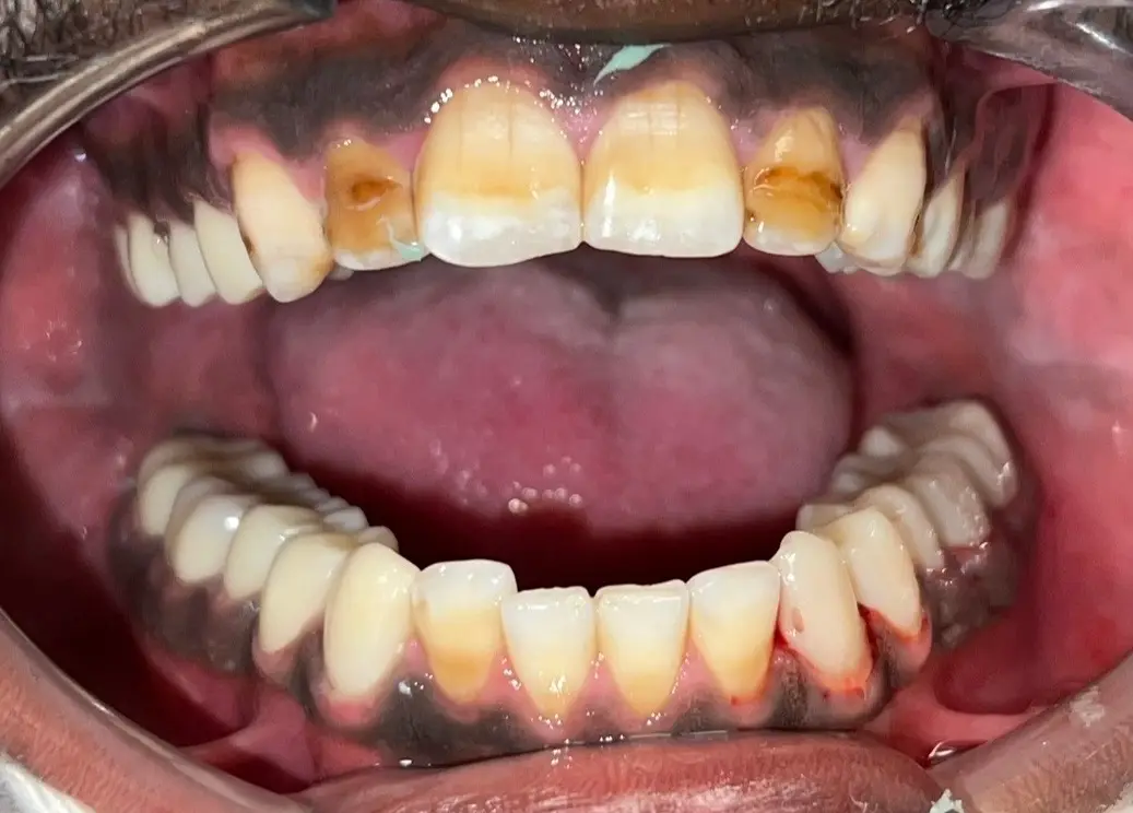 Patient's teeth before full coverage zirconium crown treatment