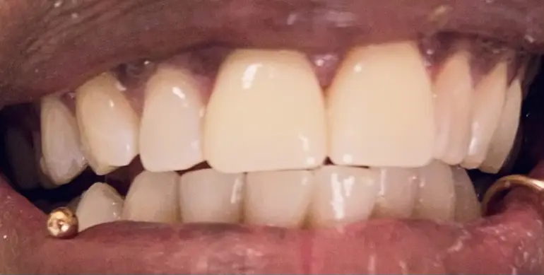Patient's smile after full coverage zirconium crown treatment