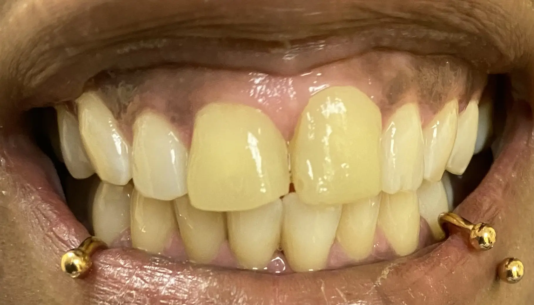 Patient's teeth before full coverage zirconium crown treatment