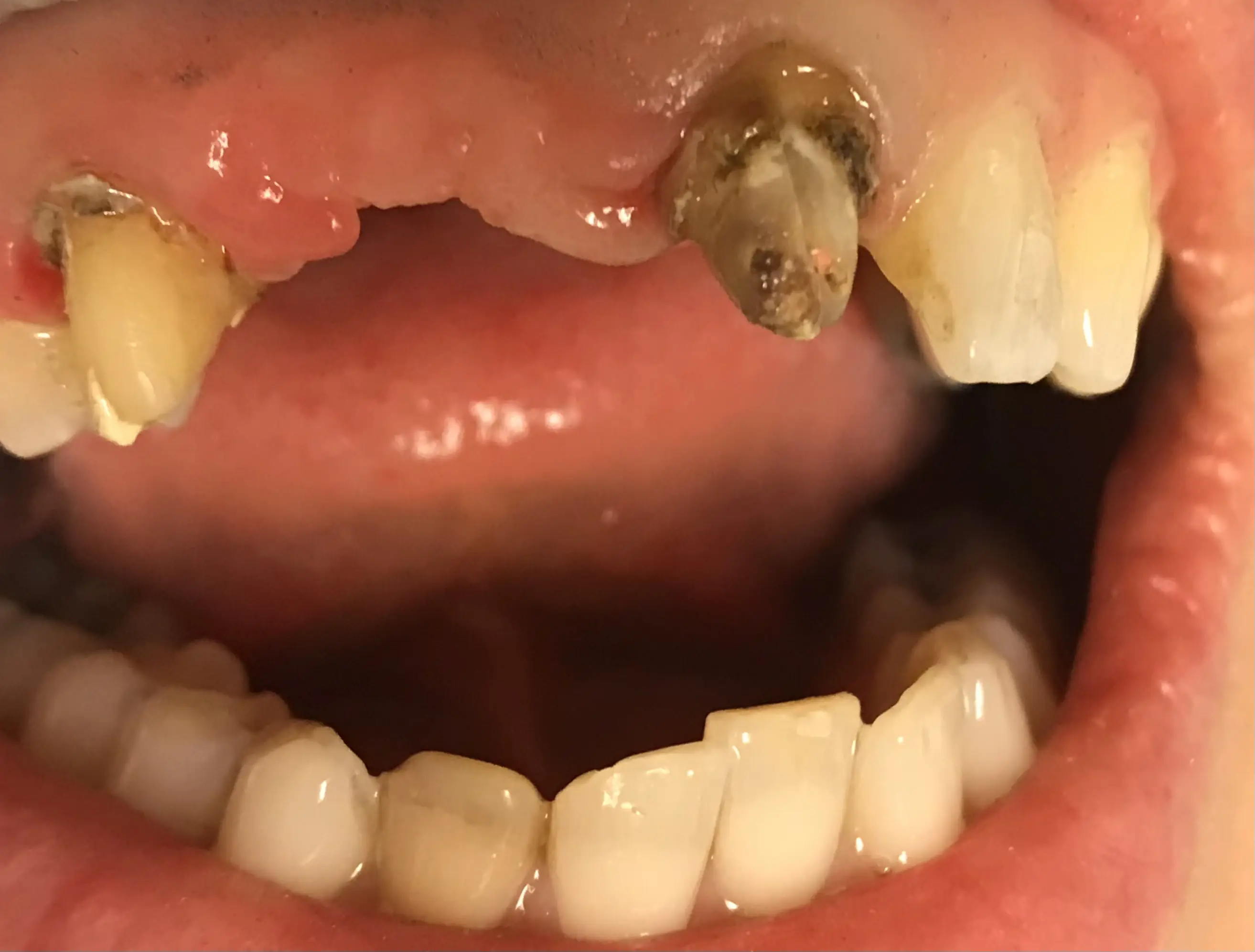 Patient's smile with a missing tooth before zirconium bridge treatment