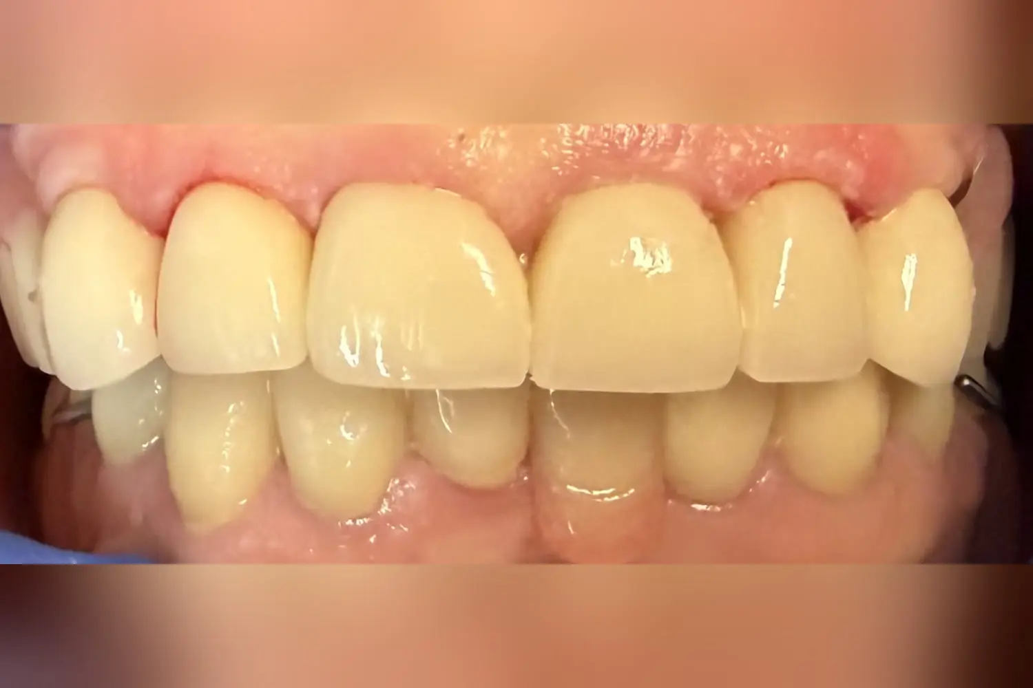 Patient's smile after full coverage crowns and a lower partial denture at Main Street Smiles, Stoneham MA